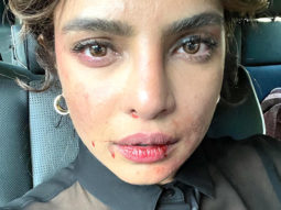 Priyanka Chopra shares a photo with a bruised face; here is how fans reacted to it