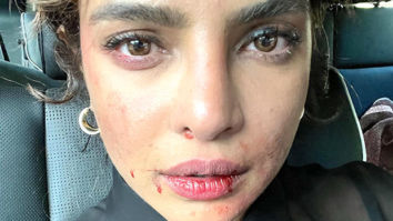 Priyanka Chopra shares a photo with a bruised face; here is how fans reacted to it