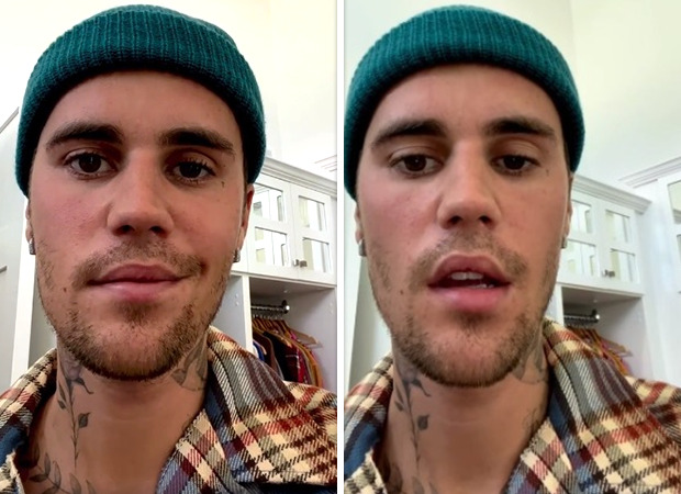 Justin Bieber suffering from partial face paralysis caused by Ramsay Hunt Syndrome - "Extremely frustrating, please pray for me" Justin Bieber suffering from partial face paralysis caused by Ramsay Hunt Syndrome - "Extremely frustrating, please pray for me"