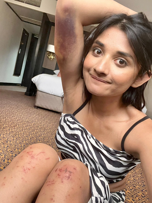 Khatron Ke Khiladi 12 contestant Kanika Mann gets bruised on the sets of the Rohit Shetty hosted show