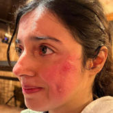 Divya Khosla gets “Badly injured” on sets of Yaariyan 2; says, “But the show must go on”
