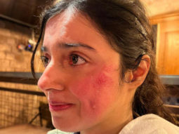 Divya Khosla gets “Badly injured” on sets of her upcoming film; says, “But the show must go on”