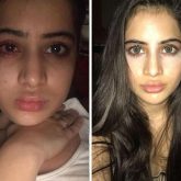 Uorfi Javed opens up about her fillers journey; says, “I’ve been getting lip fillers from the age of 18”