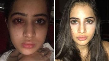 Uorfi Javed opens up about her fillers journey; says, “I’ve been getting lip fillers from the age of 18”