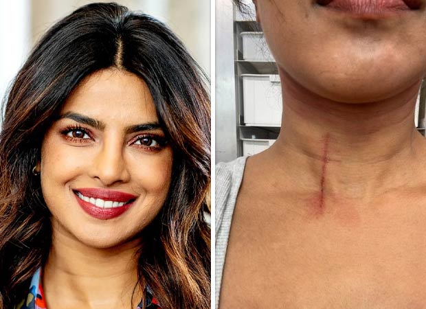 Priyanka Chopra Jonas gets injured on the sets of The Bluff; shares picture