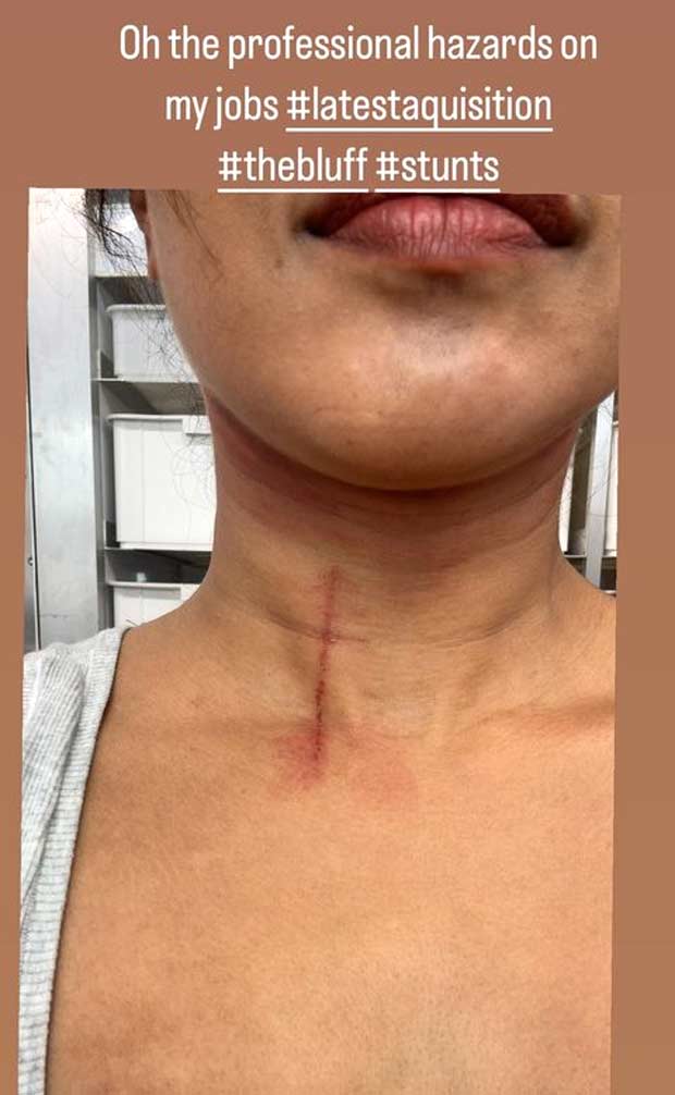 Priyanka Chopra Jonas gets injured on the sets of The Bluff; shares picture