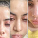 Uorfi shares SHOCKING photos of swollen face and lips, reveals she is “undergoing immunotherapy”: “Fillers nahi hai guys , allergies hai”